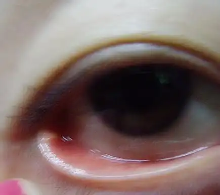 右眼睑边缘长了个白色的圆点,平的,不痛不痒