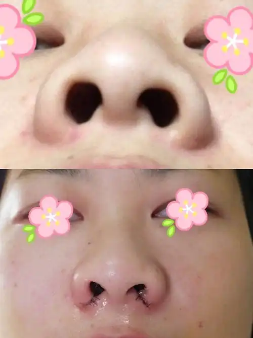 鼻基底宽鼻孔缩小