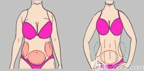腰腹抽脂能抽出马甲线吗?