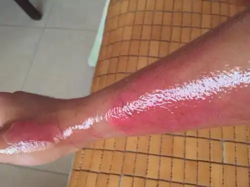 昌黎哪里做疤痕啊,小孩子手臂烫伤了