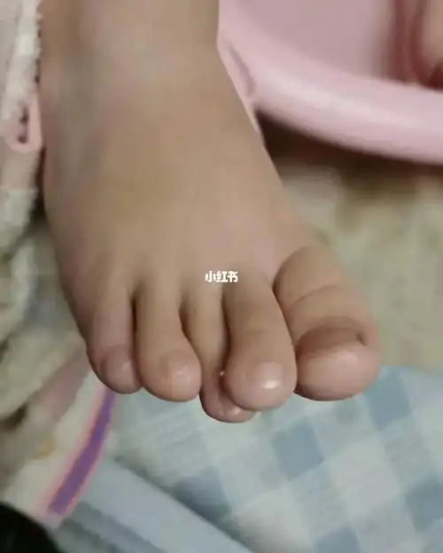 "5岁的孩子,两个脚趾重叠,会自己长好吗?