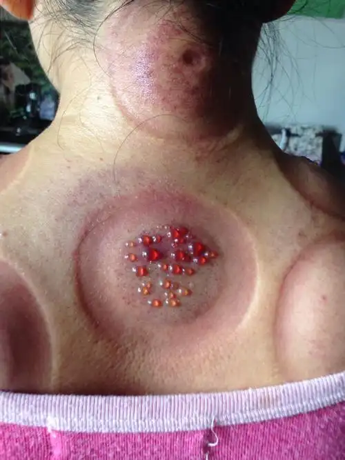 肩膀和颈子哪里很痛,我就叫我老公拔罐～抹的菜子油拔的～颈子哪里还