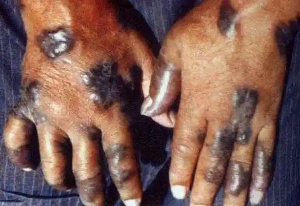 艾滋病晚期皮疹