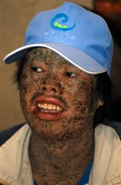 标题:云南澄江:怪病男子全身长满"鱼鳞" 以钓鱼为生