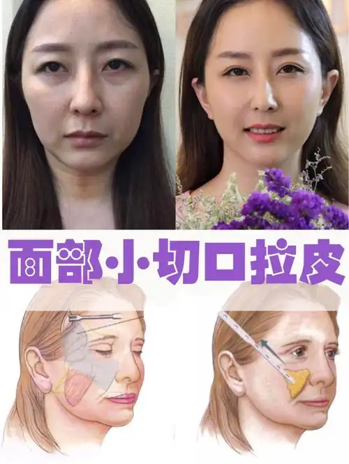 【臻美医疗美容】【面部小切口拉皮】91什么是小切口拉_圈子-新氧