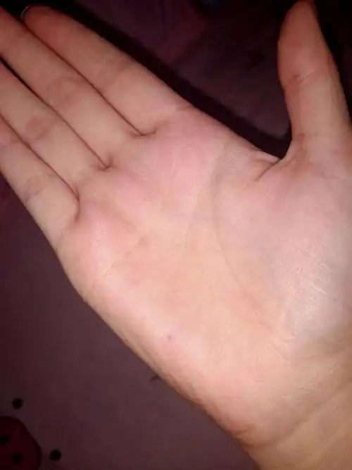 手掌心有痣代表了什么含义(手掌心有痣代表了什么含义图解)