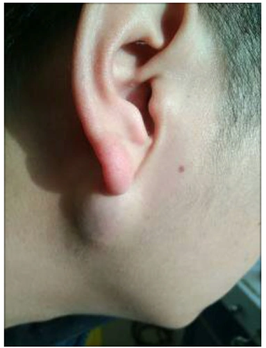 耳朵上的包块:粉瘤 - 好大夫在线