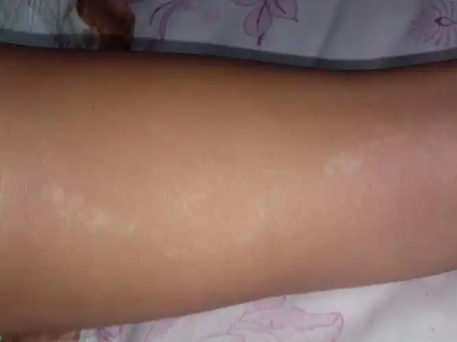 男性白癜风患者治疗有什么原则吗