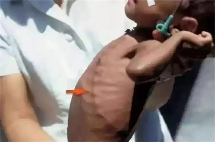 儿童重疾险包含佝偻病吗(儿童重疾险你保哪些疾病)