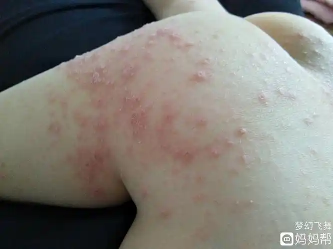 婴儿湿疹长什么样图片和症状 ( 婴儿湿疹长什么样图片)