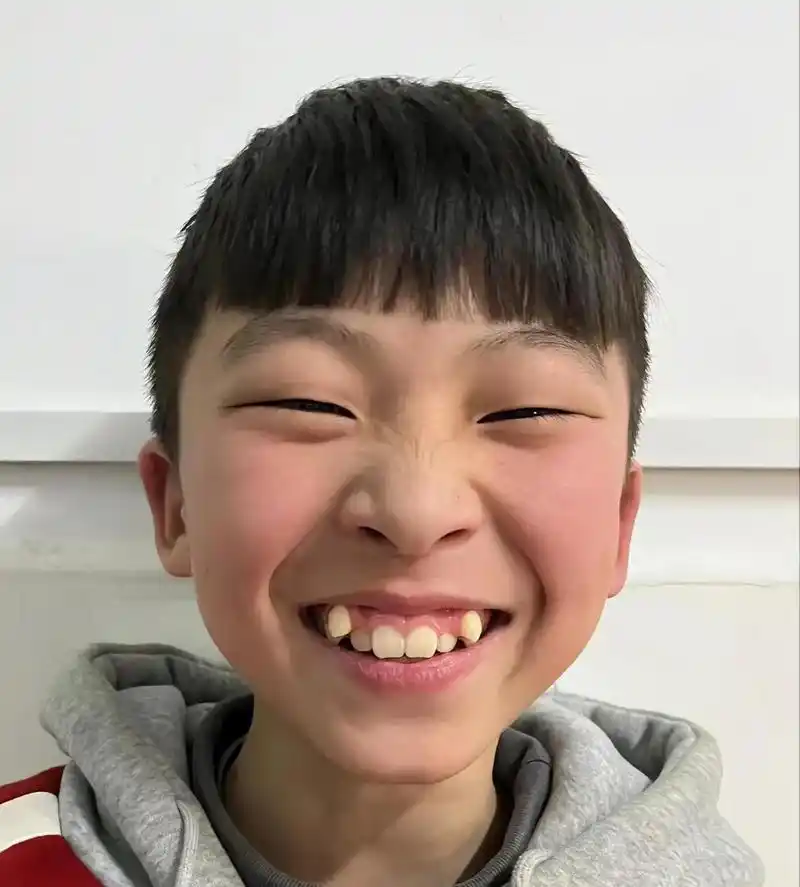 小虎牙矫正后,孩子更帅气了,花点钱,受点罪是值得的.