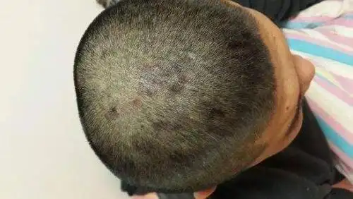 脂溢性皮炎脂溢性皮炎是一种轻度的慢性湿疹, 是发生于皮脂溢出部位的