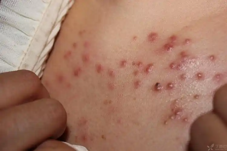 【病例讨论】胸前皮肤长片状红疹