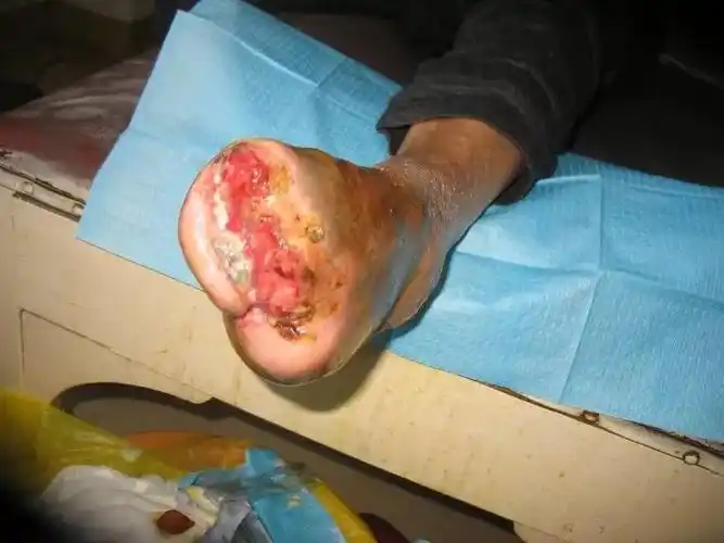 中医药疗效让糖尿病足患者告别截肢