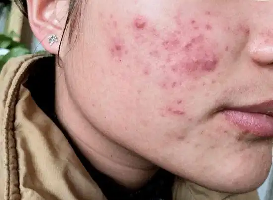 满脸长满痘痘,重度痤疮毁脸难修复,皮肤医生说:治痘得慢慢来