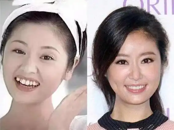 高圆圆整牙之前模样高圆圆没整牙以前照片