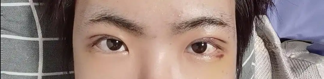 三个月反馈男生平扇双眼皮南京胡亮