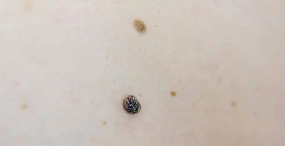 皮肤上的小肉球,小肉疙瘩是啥?