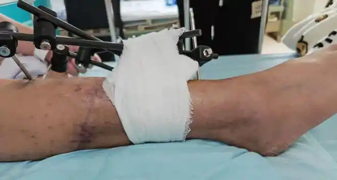 会进行截肢,但家属不想看到这一结果,希望能够接上断腿