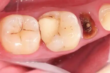 右下第一磨牙根管再治疗一例 | 郭伟强医生使用c-root sp充填案例