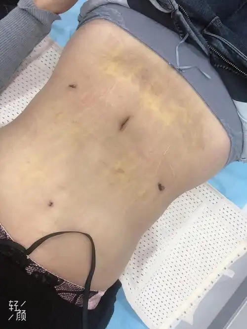 腰腹环吸后多久可以恢复术后该如何护理