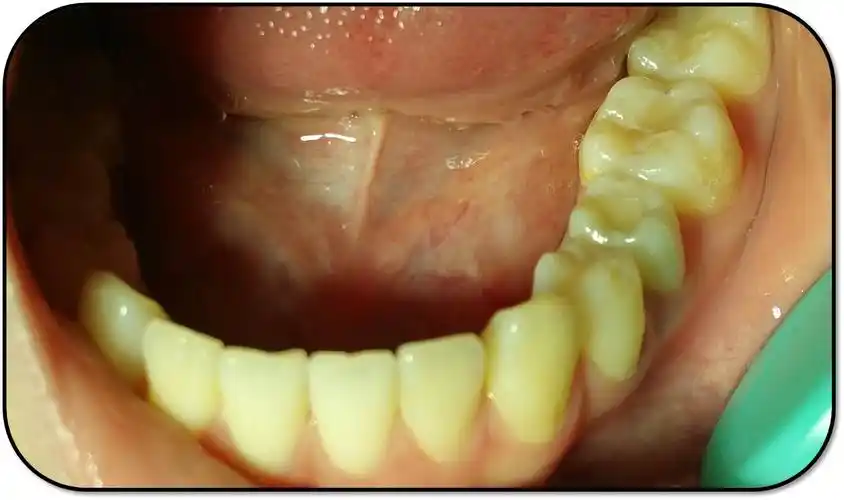 11岁儿童第二双尖牙牙髓再血管化治疗