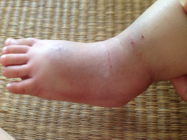 宝宝脚被什么咬了