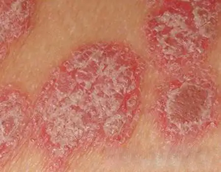 轻度银屑病图片头皮