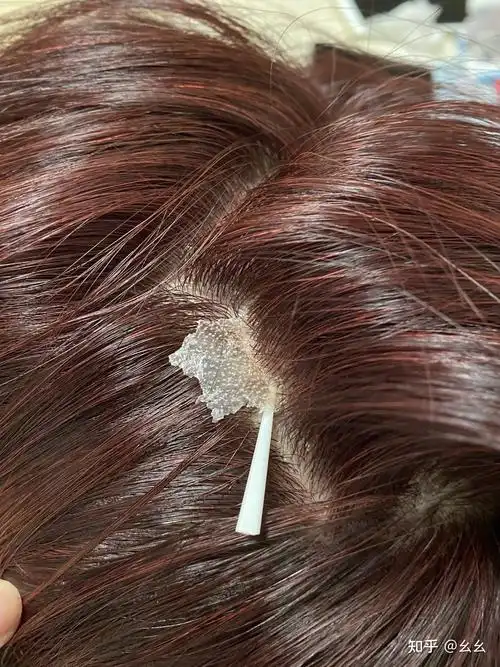 见过的最大头皮屑多大