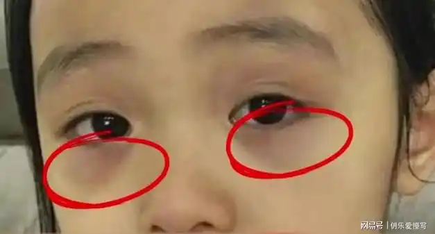 说了不止800遍了孩子有眼袋下眼睑青紫不是小事