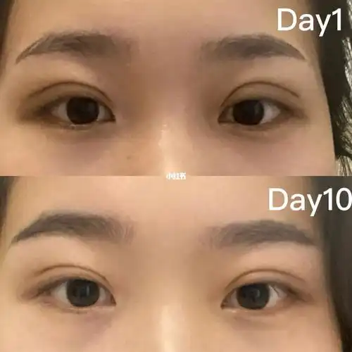 埋线双眼皮恢复第10天