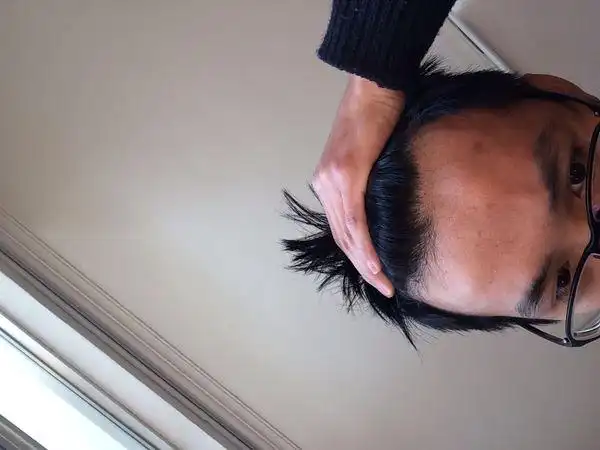 额头两侧开始向上秃我该怎么保持