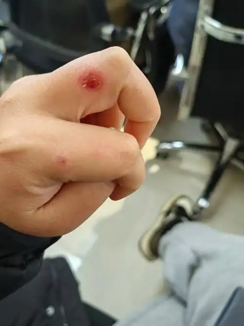 冻疮红霉素眼膏真的有用,擦了三四次后好多了