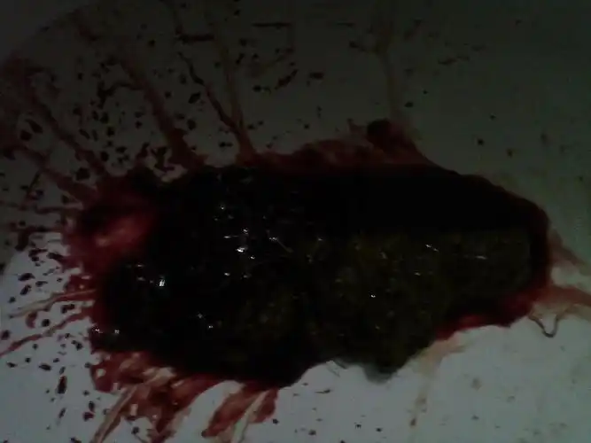 大便有大量鲜血,急请教!