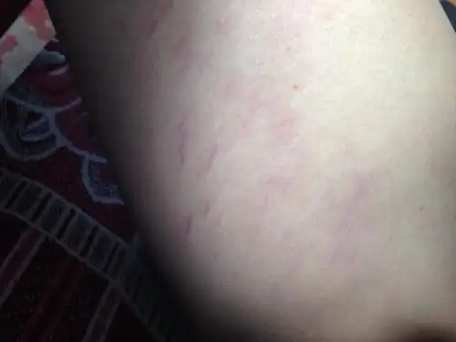 请问医生我大腿根内侧这红道道是怎么回事