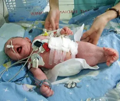 "美人鱼"男婴存活38天后夭折