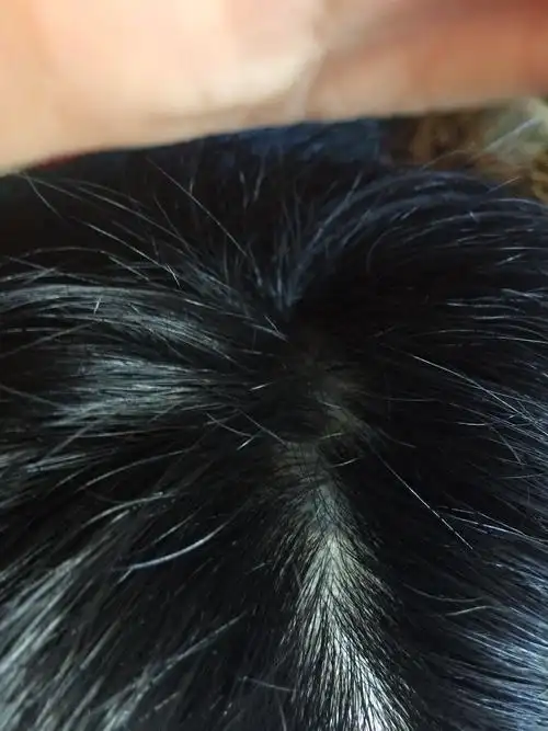 头发发根起小水泡是热症吗?是热症要怎么治疗?