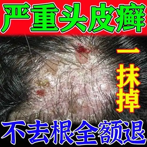 头皮癣专用药膏-特价促销-优惠券领取-价格|多少钱|什么牌子好-35优惠