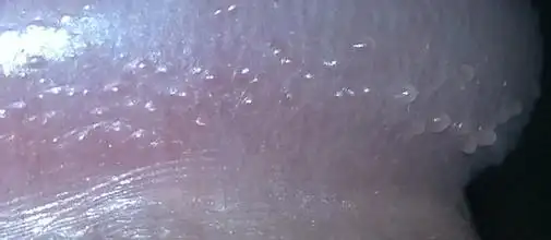 如何治疗珍珠疹~~价钱?图片》