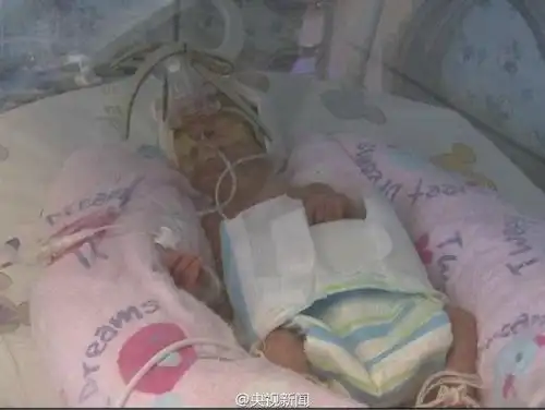 六个月大早产女婴仅有630克 胳膊如成人手指