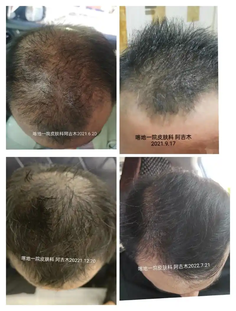 雄激素性脱发#雄秃 #男性脱发 #脂溢性脱发  - 抖音