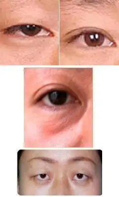 眼皮下垂是什么原因造成的?