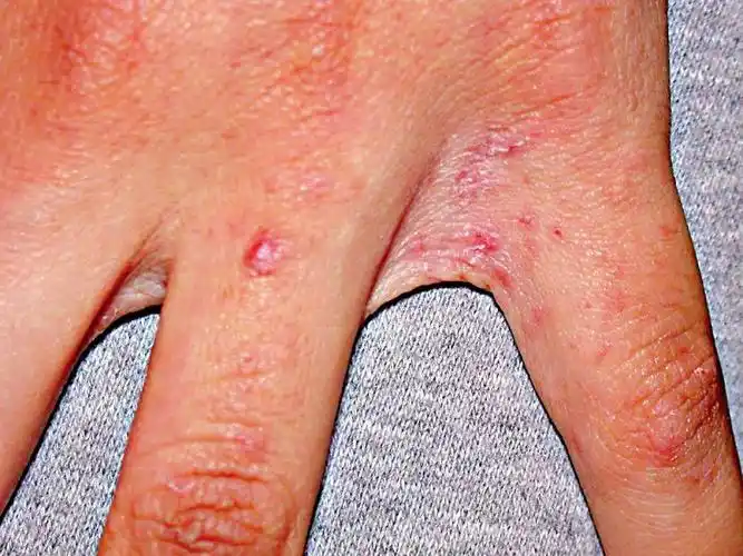 图:指缝是疥疮好发部位之一   问:医生,最近我的皮肤出现红疹,十分