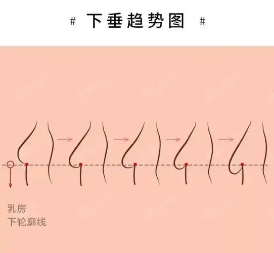 从c罩杯到a罩杯生完宝宝的第7个月后她决定隆胸