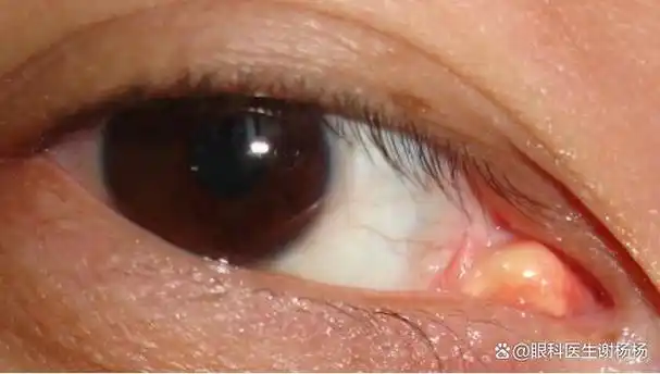 在门诊或社区义诊时,往往会遇到内眼角的那坨肉肥大的朋友.