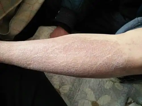 一开始皮肤瘙痒,长期抓挠.