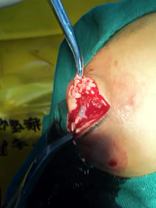 痛风结石手术中