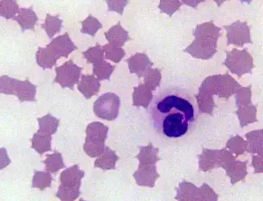 这些红细胞异常,您都掌握了吗?