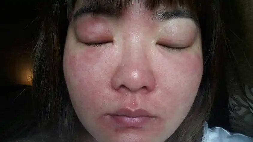 面部皮肤过敏怎么办自救