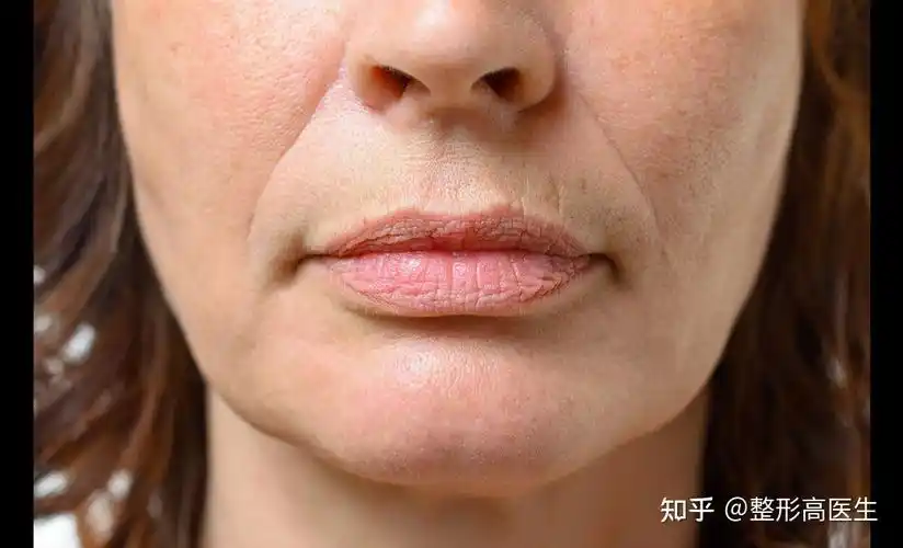 高 的想法: 因为年龄增大,皮肤松弛下垂出现法令纹加… - 知乎